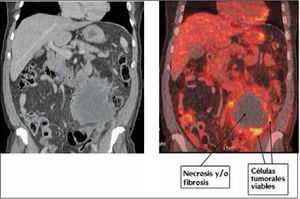 Masa abdominal en estudio. La imagen de Tomografía Computada (izquierda) y fusión PET/CT muestran una masa en hemiabdomen izquierdo con zona central hipodensa sin captación de FDG, sugerente de necrosis y/o fibrosis. Sólo la periferia de la lesión capta azúcar marcada, lo que indica viabilidad tumoral. En esta zona debe ser tomada la biopsia.