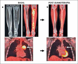 Paciente con sarcoma de Ewing en tibia izquierda. a) RM y PET/CT que muestran extensa lesión medular tibial con extensión a partes blandas en cara medial de tibia proximal (imágenes superiores), con alta captación de FDG. El PET demostró metástasis pulmonar izquierda hipercaptante (flecha blanca). b) Luego de la quimioterapia se observa significativa reducción del metabolismo glucídico en tibia, y regresión completa de la lesión pulmonar, lo que traduce una excelente respuesta a quimioterapia.