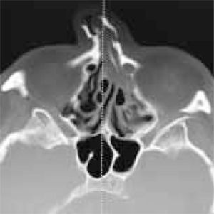 Corte axial TC, fractura y desplazamiento marcado de los huesos propios nasales.