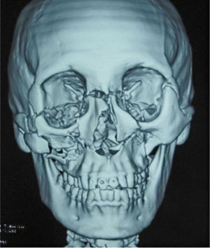 TC fractura panfacial. Rasgos de fractura combinados de fracturas Le Fort I, II, III y conminución del cuerpo de cigoma derecho.