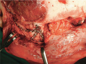 Reconstrucción quirúrgica fractura panfacial a través de acceso coronal.