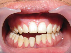 Fractura mandibular. Se observa desplazamiento dentario entre incisivos centrales y pérdida de la continuidad del arco dentario.