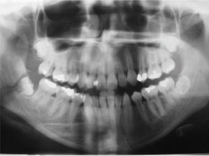 Radiografía panorámica. Fractura ángulo mandibular derecho y parasinfisiaria izquierda.