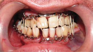 Bloqueo intermaxilar mediante arcos de Erich y elásticos en fractura mandibular.