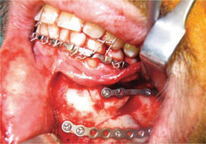 Reducción quirúrgica de fractura de cuerpo mandibular izquierdo.