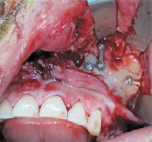 Reducción y fijación quirúrgica de maxilar con fractura Le Fort I.