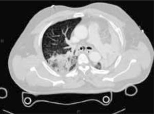 Contusión torácica bilateral en TAC de tórax. Se observa contusión de pulmón derecho y de lóbulo inferior de pulmón izquierdo.