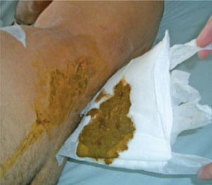 Lesión lumbar, con lesión inadvertida de colon.