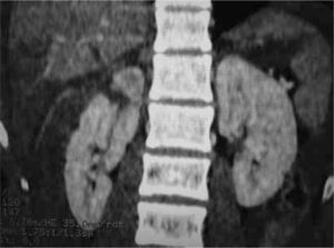 Trauma renal polo superior derecho.