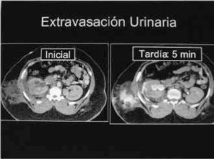 Lesión del sistema colector con urinoma de la pared. El daño al riñon es en el sistema colector urinario, por lo tanto la fase tardía revela la extravasación del contraste y la orina, hacia alrededor del riñón y la pared abdominal. Gentileza del Dr. Oscar Orellana, radiólogo HUAP.