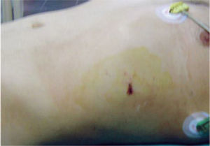 Herida tóraco-abdominal.