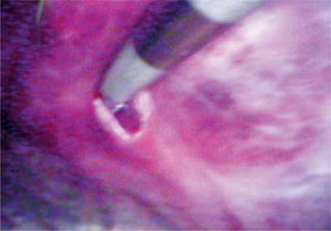 Visión laparoscópica.