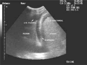 Visión ecográfica del cuadrante superior derecho del abdomen de un paciente politraumatizado, en la que se aprecia líquido libre abdominal (subfrénico) y simultáneamente líquido libre en cavidad pleural.