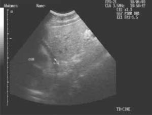 Visión ecográfica del corazón y pericardio de un paciente con un taponamiento cardiaco secundario a una herida penetrante torácica.