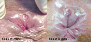Fisura anal posterior y fisuras múltiples.