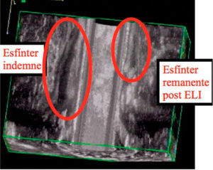 Esfinterotomia lateral interna: visión por endosonografia 3D
