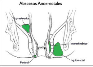 Clasificación abscesos anorrectales.