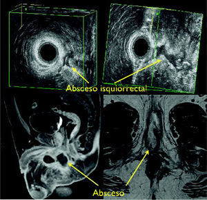 Abscesos anorrectales: Endosonografia 3D y Resonancia Magnetica.