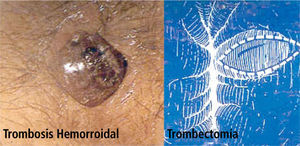 Trombosis Hemorroidal y Trombectomía.