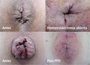 Hemorroidectomia Abierta y PPH.