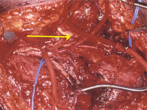 Paciente con trauma arterial en quien se instala “shunt” transitorio para traslado a centro vascular de referencia par reparación vascular.
