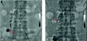 Se observa lesión de arteria lumbar, con sangrado activo posterior a procedimiento de columna (3A). Se realizó control de la hemorragia mediante la oclusión de la arteria con uso de coils intravasculares (3B).