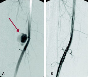 Imagen de lesión de arteria femoral superficial con arma blanca (4A), que se repara mediante la instalación de un stent cubierto (4B), manteniendo la permeabilidad de la arteria.