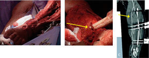 Paciente atropellado en la vía publica, ingresa con severo compromiso de pierna izquierda con sección de vasos de la misma (5A), se realiza bypass popliteo - pedio con safena de pierna derecha (5B). Control postoperatorio con scanner muestra bypass permeable (5C).