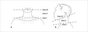 División horizontal del cuello en 3 zonas, las cuales en relación al compromiso vascular tienen distinto enfrentamiento terapéutico.