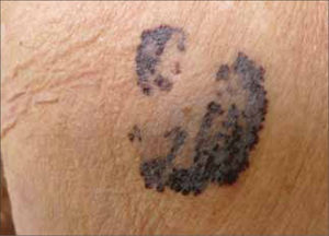 Melanoma Extensivo Superficial.