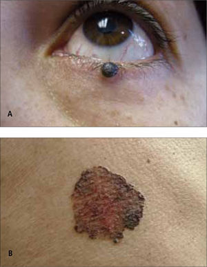 Carcinoma basocelular pigmentado.