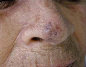 Queratosis actínica pigmentada.