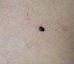 Angioma trombosado.