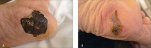 A y B. Melanoma Lentigoso Acral.