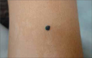 Nevus de Spitz pigmentado.