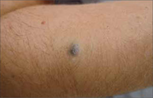 Nevus Azul clásico.
