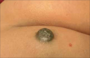 Nevus Azul celular.