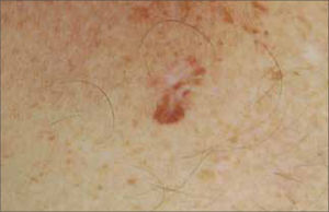 Nevus recurrente.