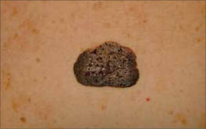 Queratosis seborreica pigmentada.