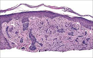 C.B morfeiforme (de Dermathopathology Interactive Atlas).