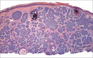 C.B micronodular.