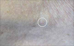 Aspecto de un C.B a ojo desnudo. En el círculo se aprecia pequeña pápula color piel.