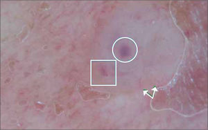 C.B con dermatoscopio. Nodulos ovoideos (círculo), telangiectasias (flecha) y glóbulos de pigmento (rectángulo.).