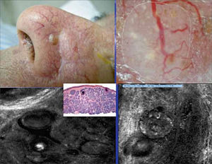 Imágen con M.Confocal (mitad inferior), corte horizontal donde se aprecian los nódulos tumorales.
