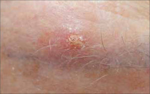 Queratosis actínica ceja izquierda.