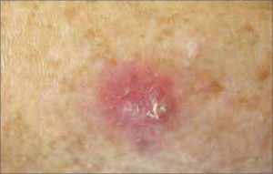 C.E evolucionando a partir de una Queratosis Actínica.