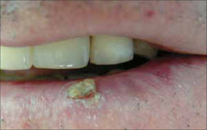 C.E labio inferior.