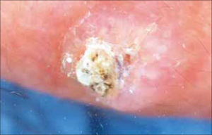 Queratoacantoma pabellón auricular.