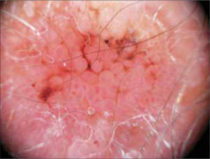 Queratosis actínica bowenoide con aspecto caraterístico de frambuesa con el dermatoscopio.