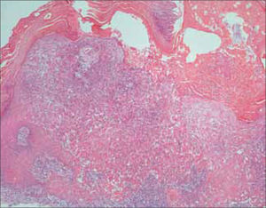 Queratoacantoma.